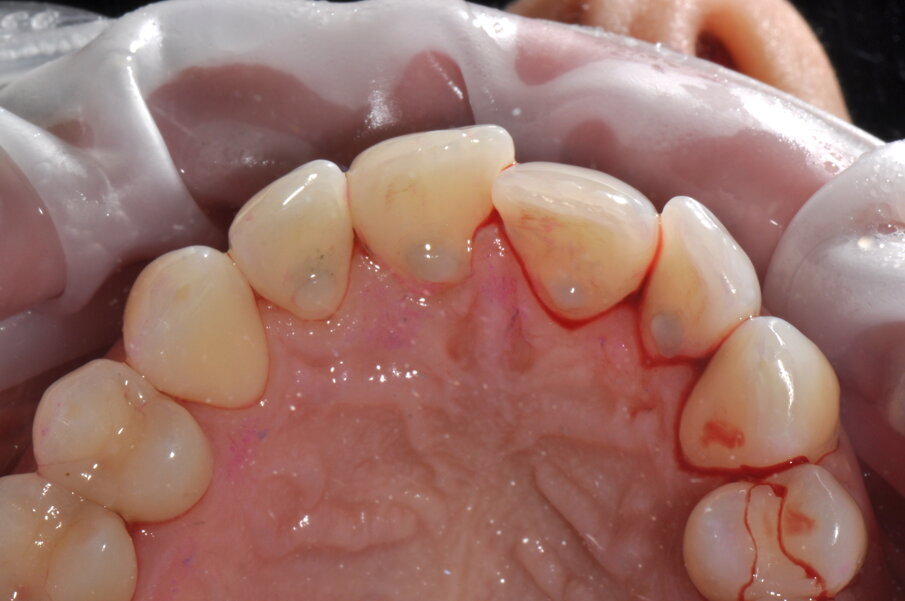 Figg. 2a-2c - Foto scattate dopo l’utilizzo del manipolo sopra-gengivale, nelle aree vestibolare (2a), palatale (2b) e linguale (2c), senza la detartrasi con strumento piezoelettrico.