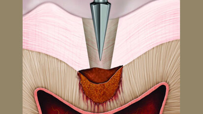 La preparación cómoda de cavidades es la clave del éxito