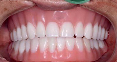 L’apport des solutions CFAO aux restaurations complètes sur implants