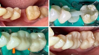 El puente reforzado como alternativa al implante