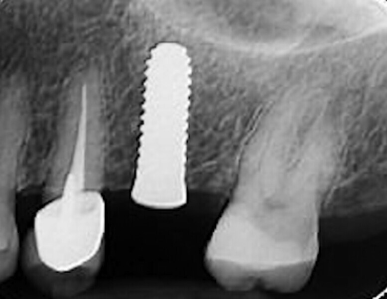 Fig. 44 : Radiographie de contrôle et excellente intégration de l’implant en céramique dans l’environnement parodontal.