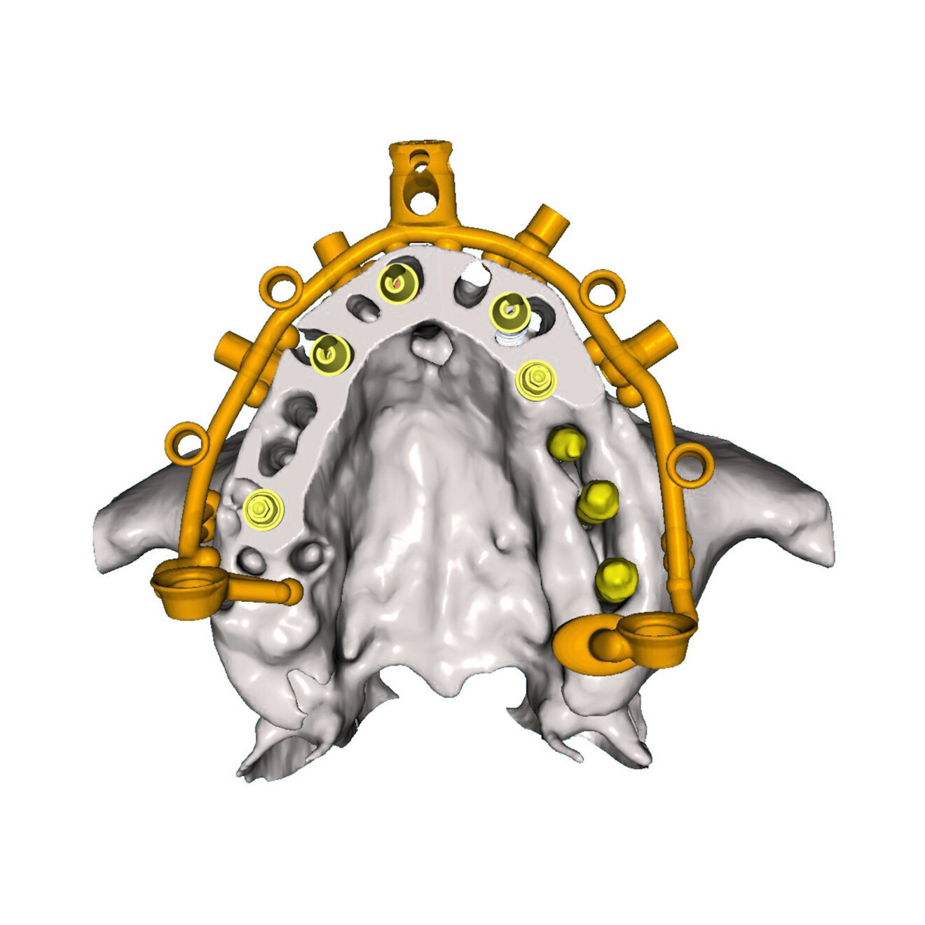 Fig. 15a: Simulated prosthetic workflow. Occlusal view of the planned implants and MUAs with the base frame.