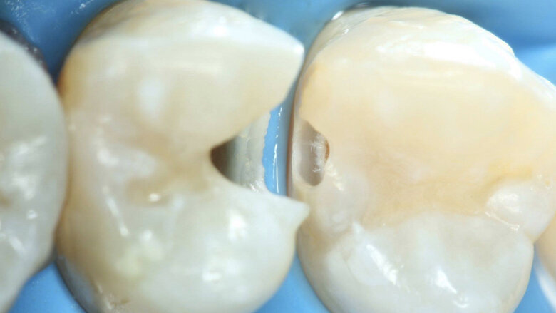 Figuras 21, 22 y 23. Se coloca a través de esa cavidad el agente enzimático Brix3000 para la remoción químico-mecánica.