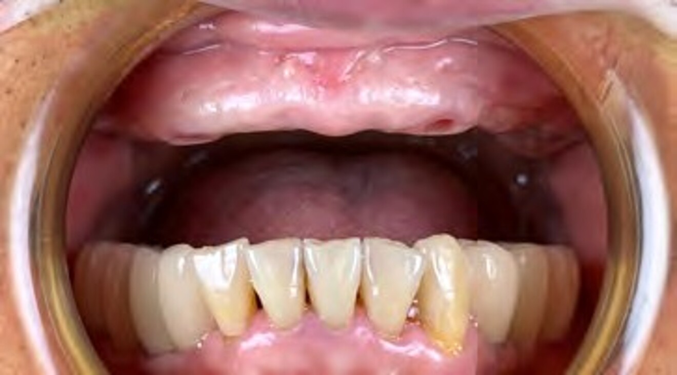 Fig. 2i: Frontal intraoral view following completion of  the mandibular implant-supported restorations, demonstrating improved aesthetics and occlusal support.