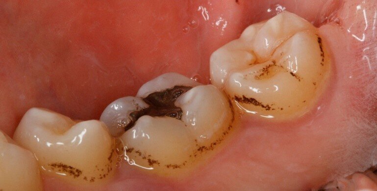 Fig. 5a - Fotografia del quarto sestante linguale al primo rilievo delle black stains.