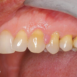 Estetika parodontu s využitím laserů na měkké tkáně