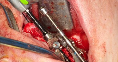 Tecnica completamente guidata nella riabilitazione del mascellare atrofico con impianti zigomatici