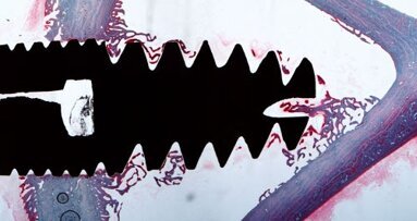 Учени подобряват успеваемостта на зъбните имплантати