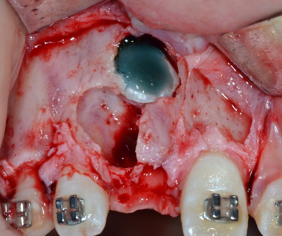 Fig. 16_Fasi di adesione per la cementazione di un attacco ortodontico.