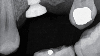 Endodonticko – implantologický algoritmus