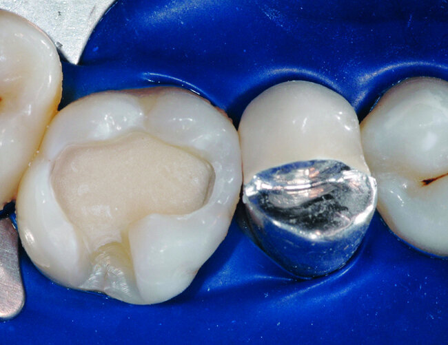 Fig. 12 : Vue clinique apres mise en place et retaille du substitut dentinaire
(CVIMAR : Fuji II LCR GC) en technique ≪ sandwich ferme ≫