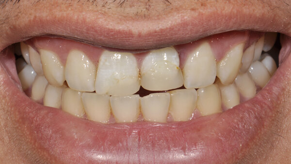 Biomimética con un sistema de color inteligente