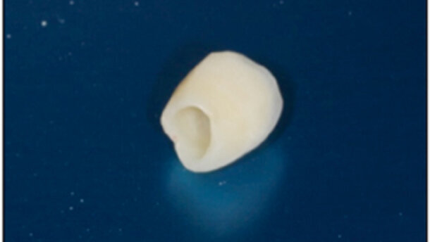 Implantes postextracción. ¿Una alternativa a la preservación alveolar?  Revisión de la literatura