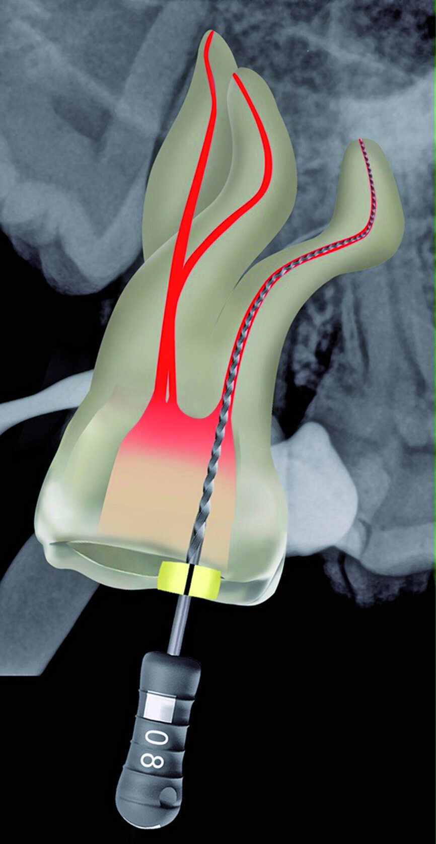Fig. 19: Canals were carefully negotiated to full working length using pre-curved size 08 K-Files.