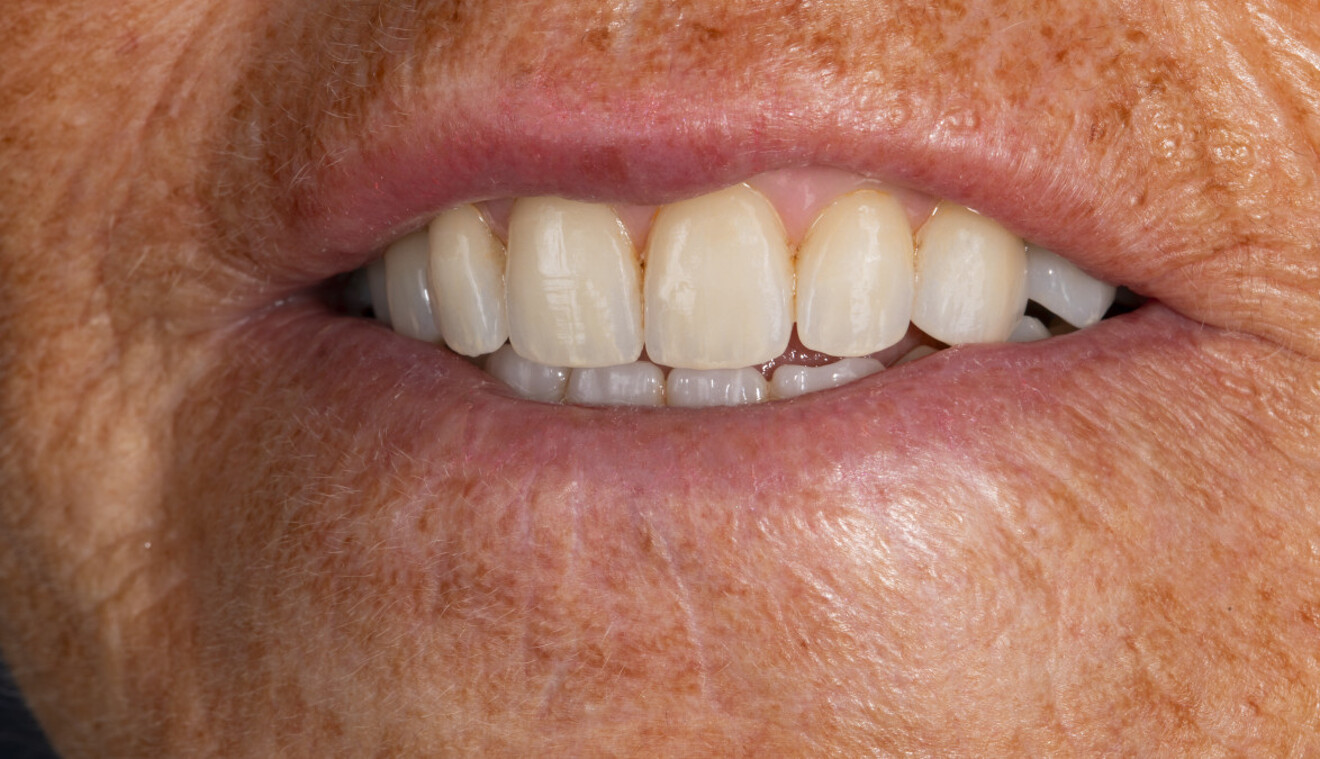 Fig. 15b: Extra-oral angled view of the final result.