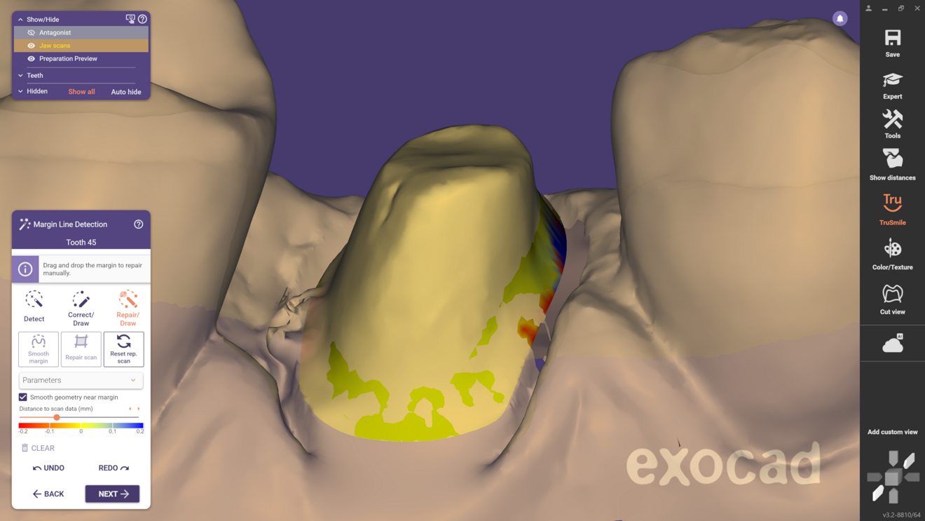 Fig. 2: As soon as the new preparation margin is determined, the corrected stump can be seen in yellow. Only the lower area, directly at the border, deviates clearly from the original scan.