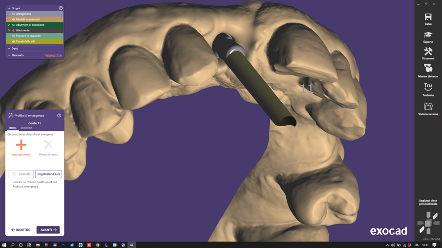 Figg. 2, 3_La scelta dello spazio cemento viene deciso in fase iniziale di accoppiamento della libreria con la scansione e rivalutabile all’interno del progetto CAD rientrando in “Expert Mode” e cambiando la libreria selezionata inizialmente. Medesima procedura si utilizza per la scelta dell’angolo del canale vite, scelto inizialmente e rivalutato durante l’avanzamento del progetto CAD.