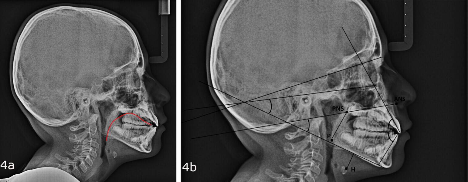 Figs. 4a & b: Cephalometric radiograph, showing (a) lingual position analysis (red line) and (b) points and planes of functional cephalometric analysis. PNS = posterior nasal spine; ANS = anterior nasal spine; H = hyoid bone; P = tip of the soft palate.