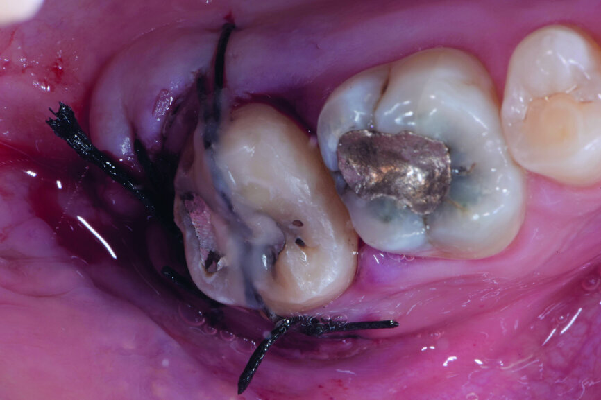 Fig. 8: Transplanted tooth sutured, immediately after surgery.