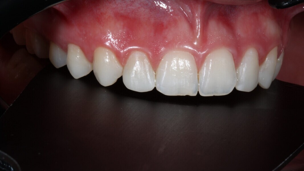 Fig. 16a: Zijaanzicht van de finale restauraties. 