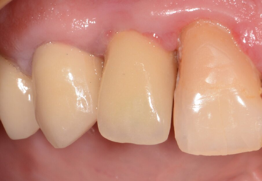 Fig. 7: Final results after three months. No sign of inflammation.