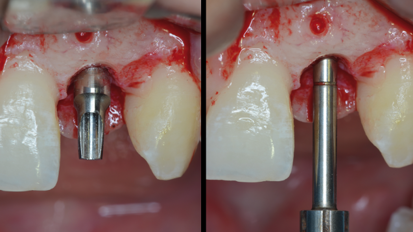 Lateral maxillary incisor implant—Key issues for esthetic success Part II