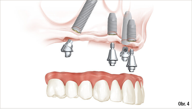 Nové delší a kratší verze implantátů z řady NobelSpeedy byly zavedeny, aby mohlo ještě více pacientů těžit z osvědčených výhod koncepce ošetření All-on-4®