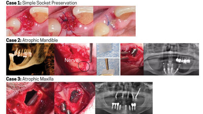 The most versatile barrier membrane for oral/maxillofacial applications