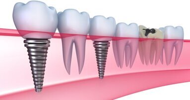 Nieuwe coating verbetert bothechting aan implantaten
