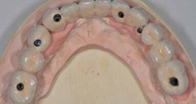 Rehabilitacja bezzębia w żuchwie przy użyciu 6 implantów