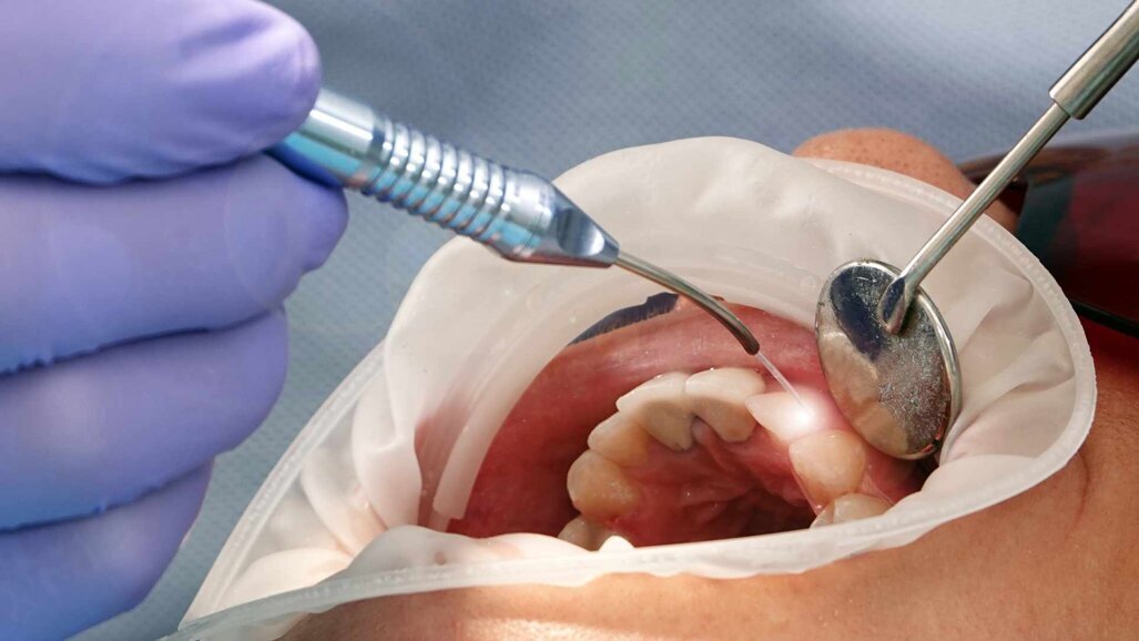 Studie: Laserlicht löst Kronen, Veneers und Brackets