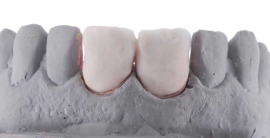 Fig. 6: Building the veneers up for the first firing