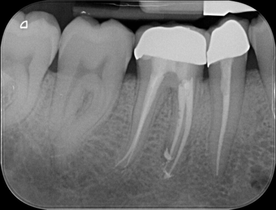 Afbeelding 14. Bij de Squirt-techniek wordt guttapercha direct in de kanalen gespoten.