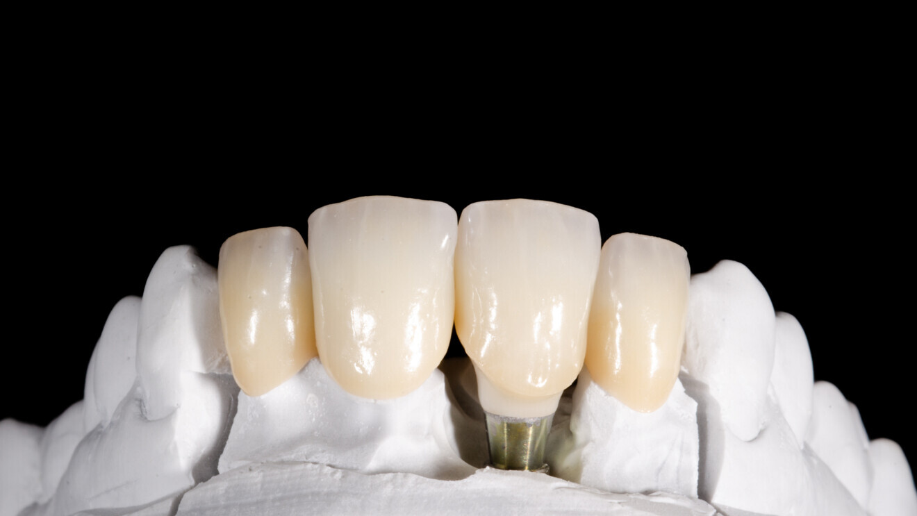 Fig. 3: Subtle internal stain adjustment to the ceramic, mostly on the incisal part. 