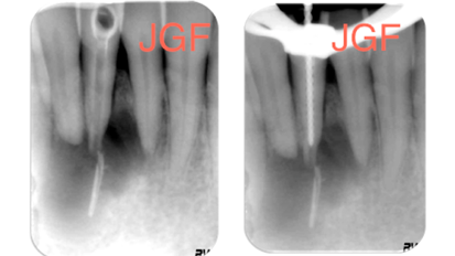 La reparación de la lesión apical compleja