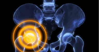 Rare fratture atipiche del femore. Un effetto di classe dei bisfosfonati