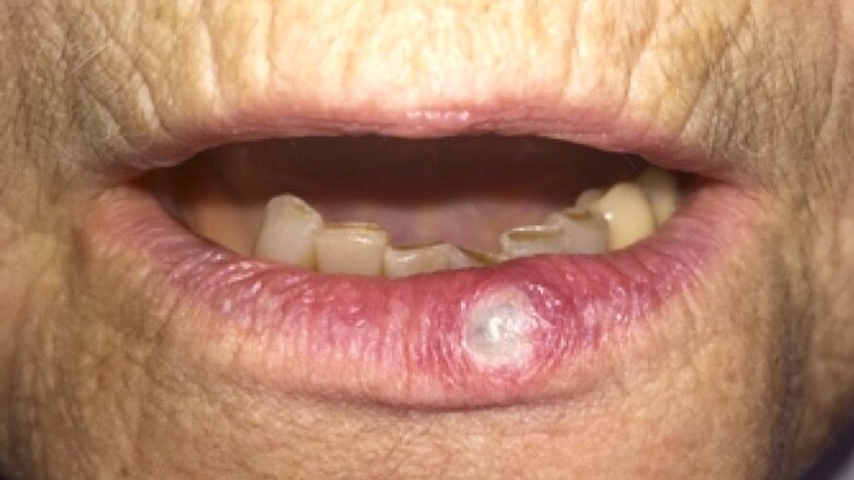 Fig. 4. Aspecto de la lesión una semana después del tratamiento.
