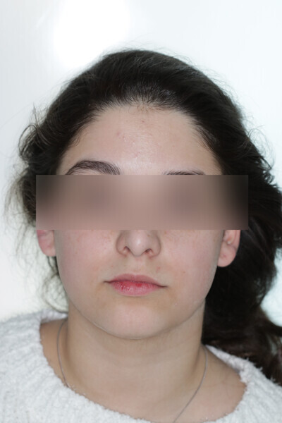 Fig. 1: Initial situation. Class II malocclusion patient.