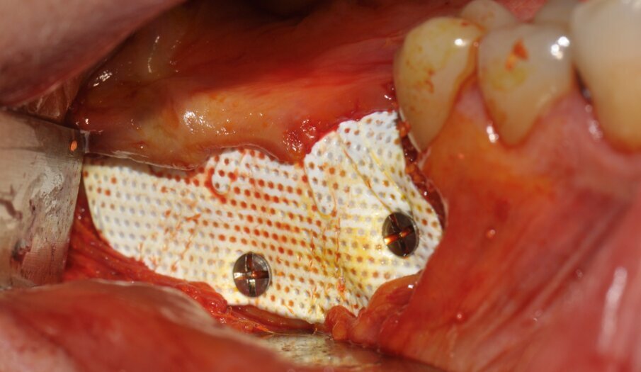 Figg. 7, 8_La membrana Cytoplast viene fissata vestibolarmente ed il lembo viene suturato.