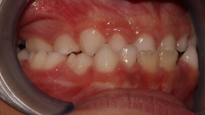 Management of maxillary transverse deficiency in children using a newly designed arch conformer