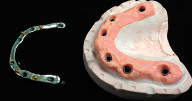 Soluzioni digitali per una protesi su barra