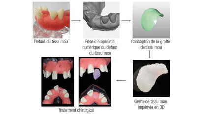 Approche de l’impression 3D en dentisterie