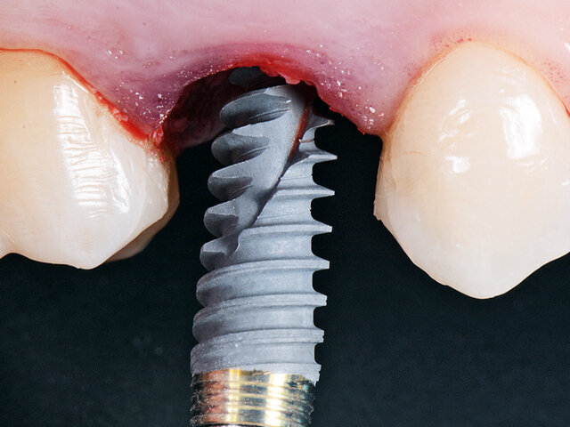 Nobel Biocare Services AG, s laskavým svolením dr. Giacoma Fabbriho