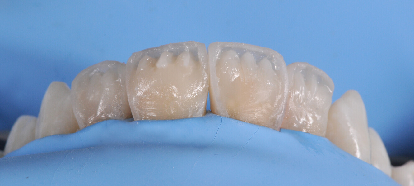 Fig. 15: Dentinal core built up with CLEARFIL MAJESTY ES-2 Premium in the shade A2D. CLEARFIL MAJESTY ES Flow Super Low in the shade XW was applied to form the mamelons, and CHROMA ZONE COLOR STAIN Blue (Kuraray Noritake Dental) was used to reproduce incisal translucencies in the spaces not covered by the dentinal core.