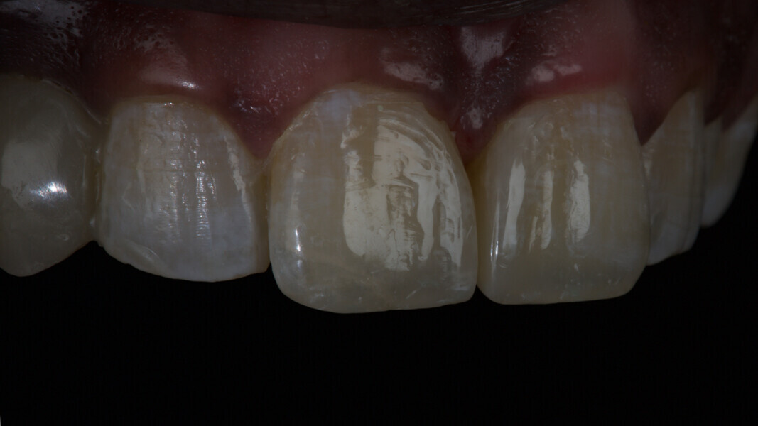 Fig 28 The textures were well replicated and gave the life-like appeal to final restoration.