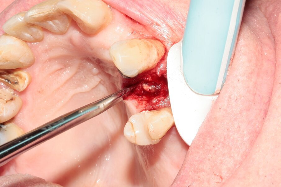 Figs. 10–12: The fractured root was carefully luxated with Luxator P1 and Luxator L3S.