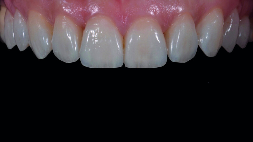 Fig. 17a: Final outcome one week later.