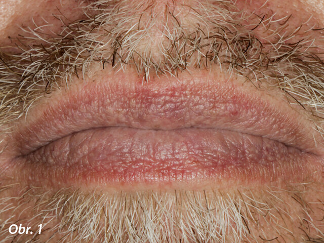 Extraorální frontální pohled.