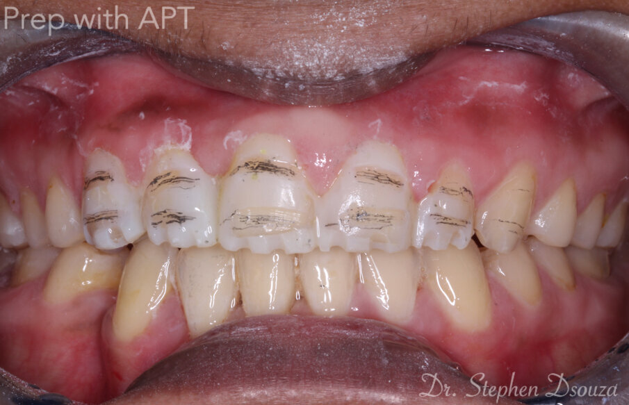 Fig. 9: Depth cuts on APT.