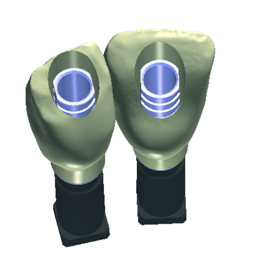 Figs. 6a et b : Réalisation d’un trou en face palatine des couronnes provisoires, permettant le rebasage au fauteuil. Notez la facilité d’insertion des couronnes à travers les piliers provisoires.